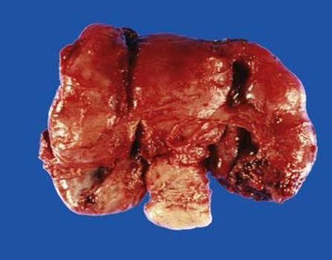 Pelvic inflammatory disease (PID)