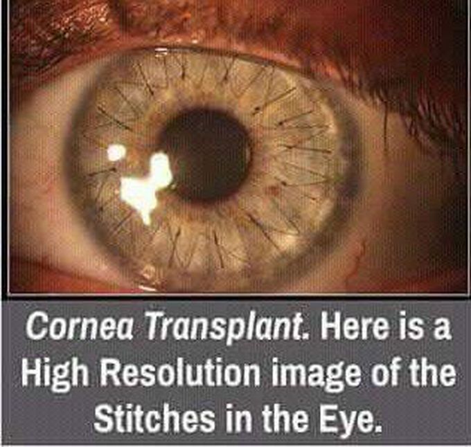 Cornea transplant