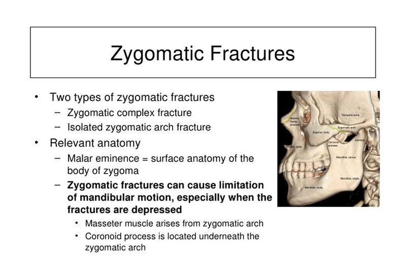 zygomatic arch fracture symptoms