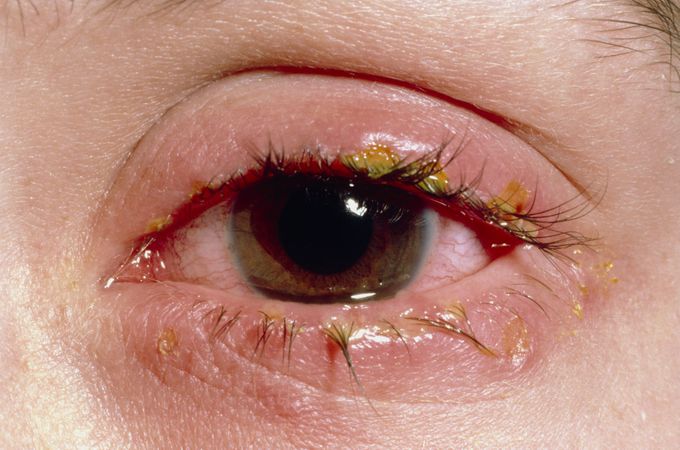 Blepharitis