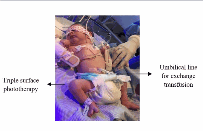 Indications of Exchange Transfusion