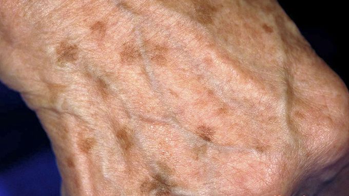 Macules
