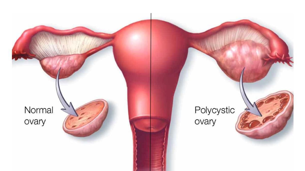 Rotterdam Criteria for diagnosing PCOS MEDizzy