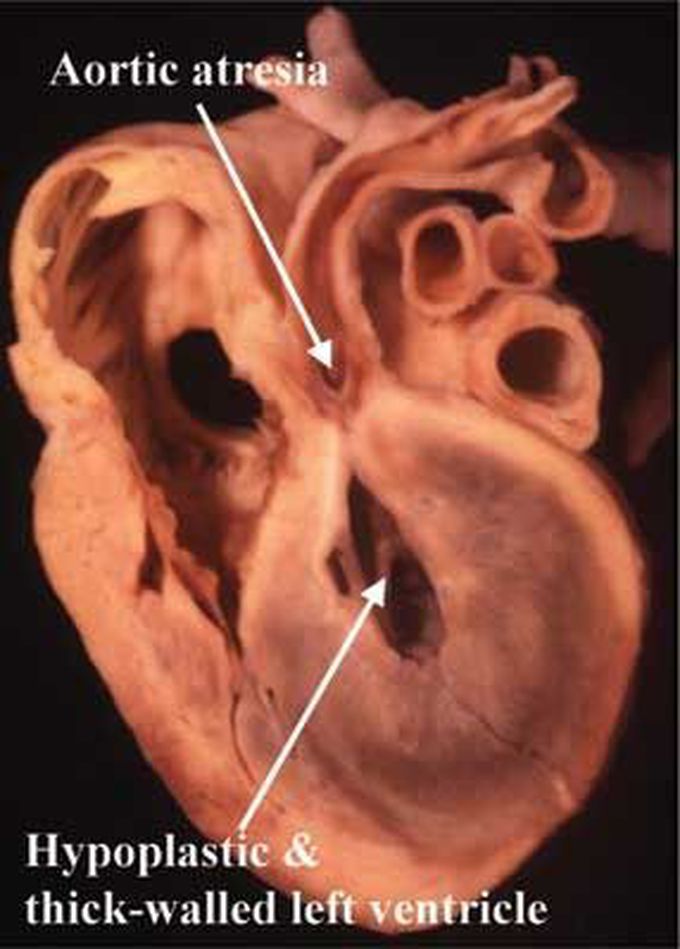 Hypoplastic Left Heart Syndrome