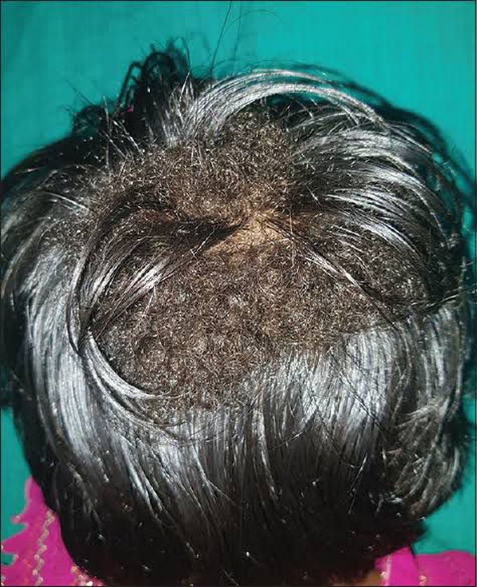 What is Wooly Hair Nevus Syndrome?
