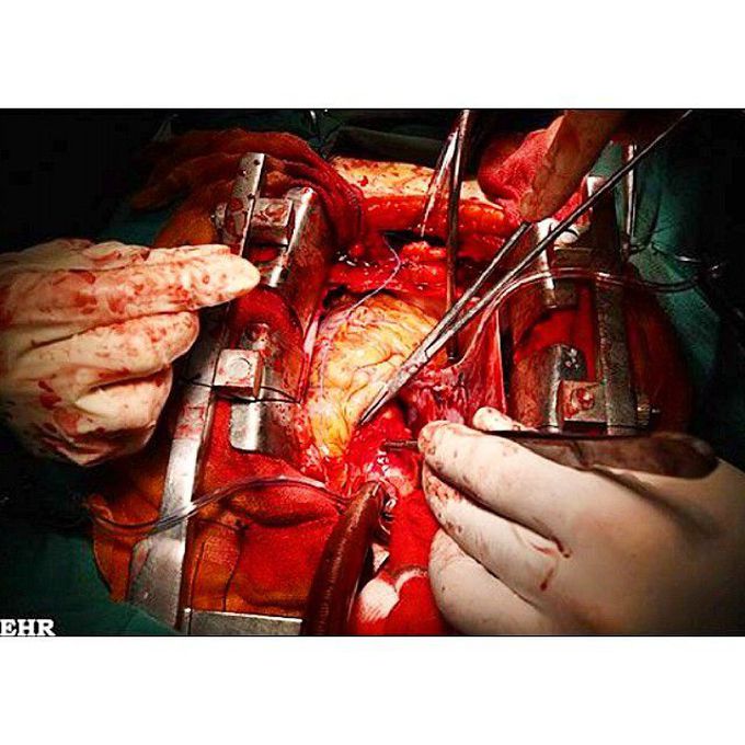 Open heart surgery, for all the Cardiothoracic lovers.