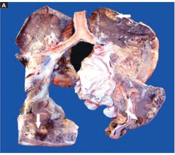 Lung abscess