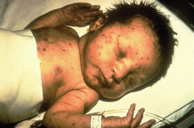 Complications of TORCH Infections in Pregnancy
