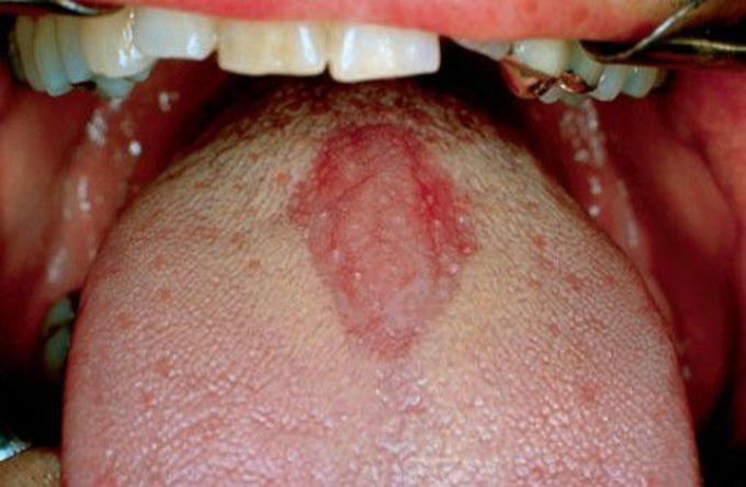 Chronic hyperplastic candidiasis or median rhomboid glossitis