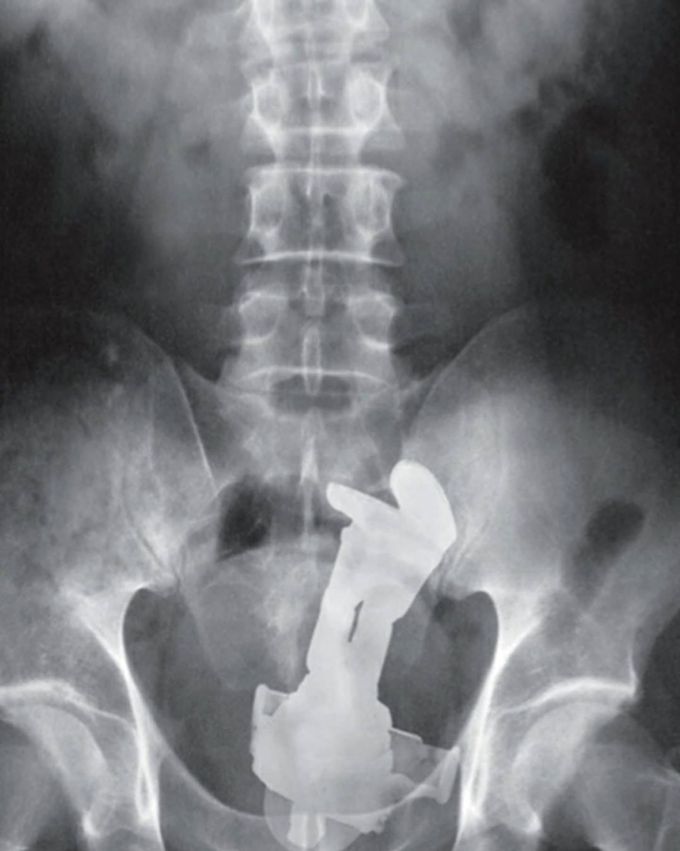 Rectal foreign body! Can you name the object?