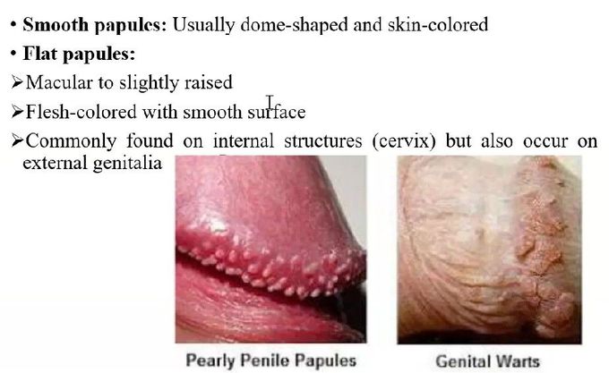 Human papiloma virus (hpv) infection in male genitalia