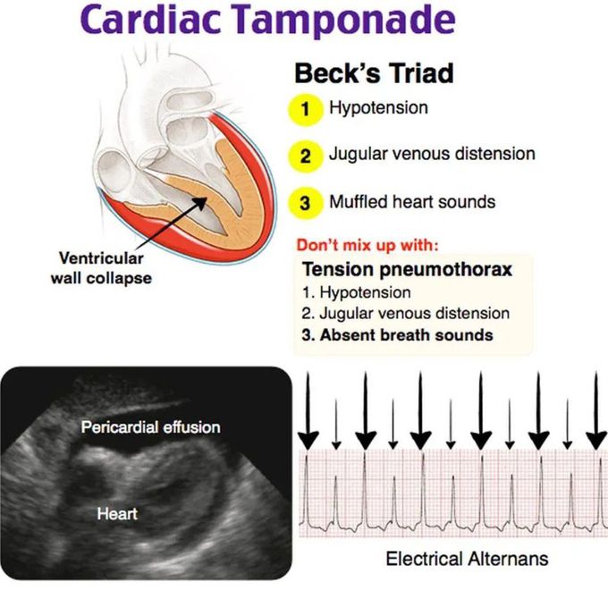 Cardiac Tamponade