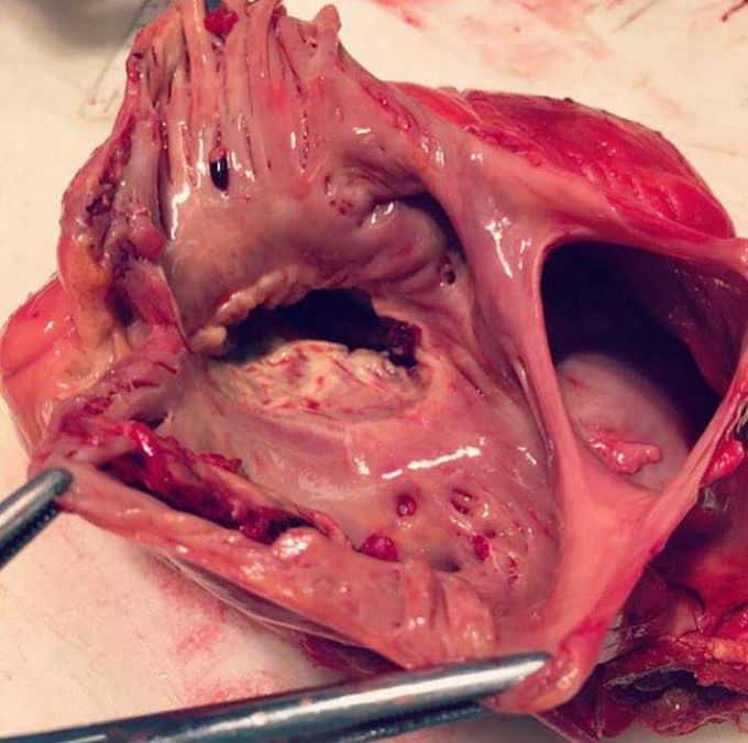 A view of heart with ASD-Atrial Septal Defect