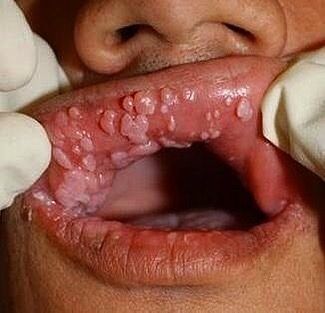 warts in throat pictures