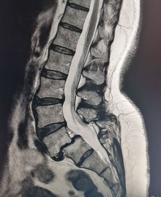 Anterolisthesis LV-SI - MEDizzy