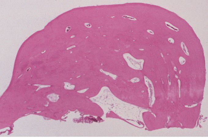 Torus mandible histopathology