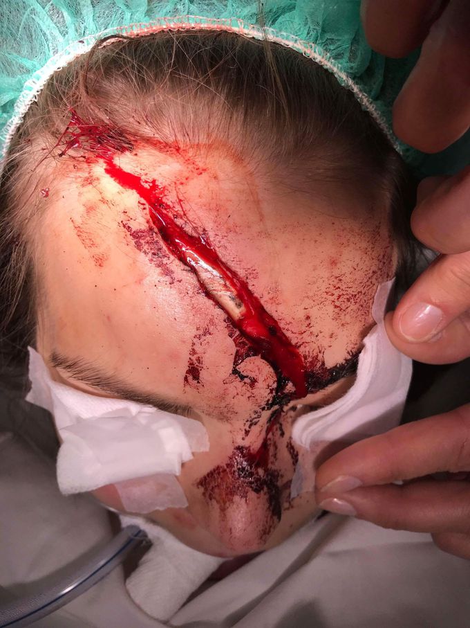 Forehead and nose injured in a car accident