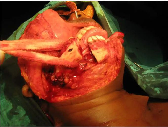 Unicystic Ameloblastoma of The Mandible