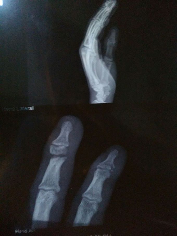 Fracture
