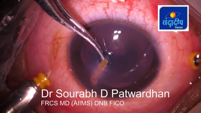 20 mm wooden intraocular foreign body