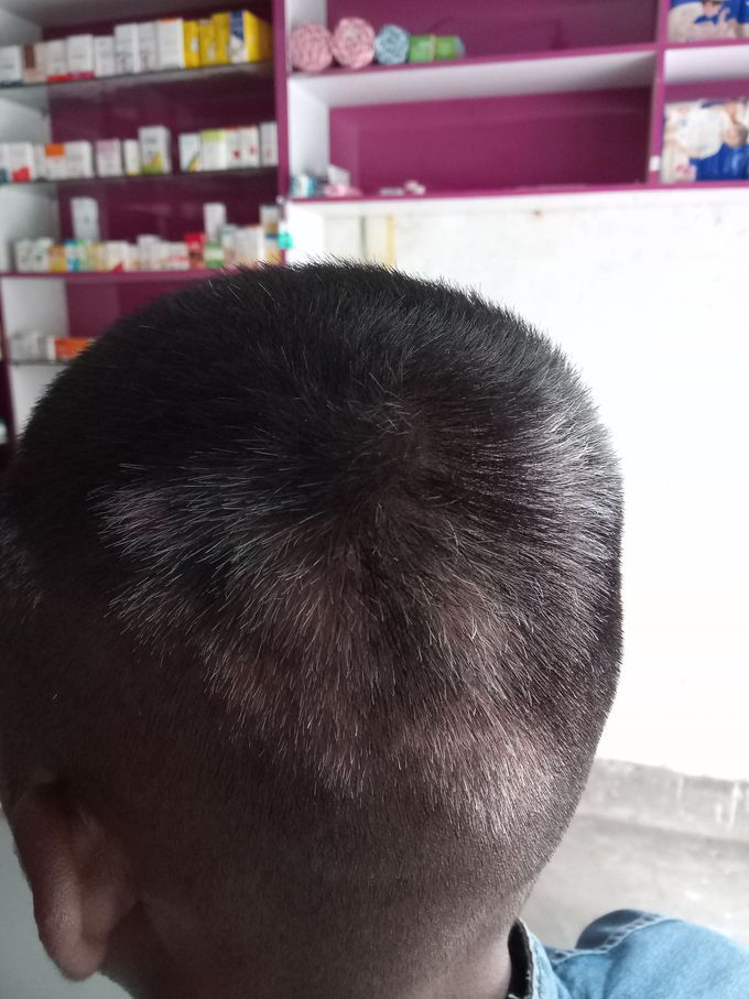 white spot in the scalp... the hairs are also goes to - MEDizzy