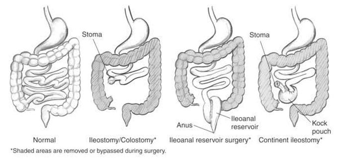 Bowel Diversion Surgery