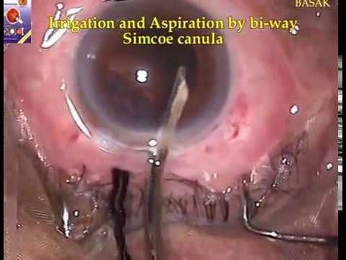 EXTRACAPSULAR Cataract Extraction