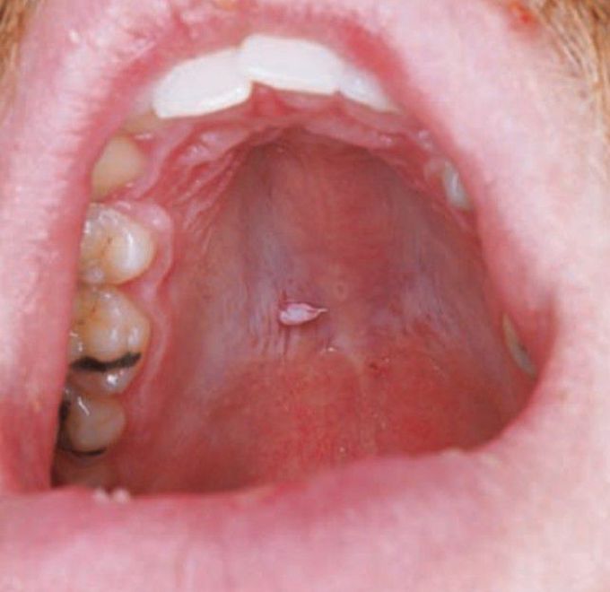 Oral wart