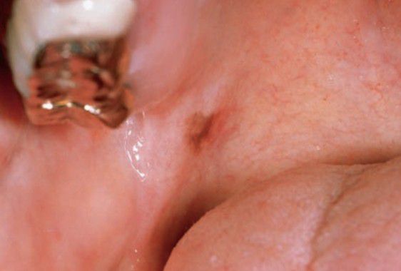 Intramucosal nevus - MEDizzy