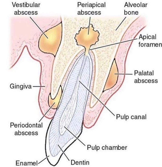 Types of Oral Abscesses