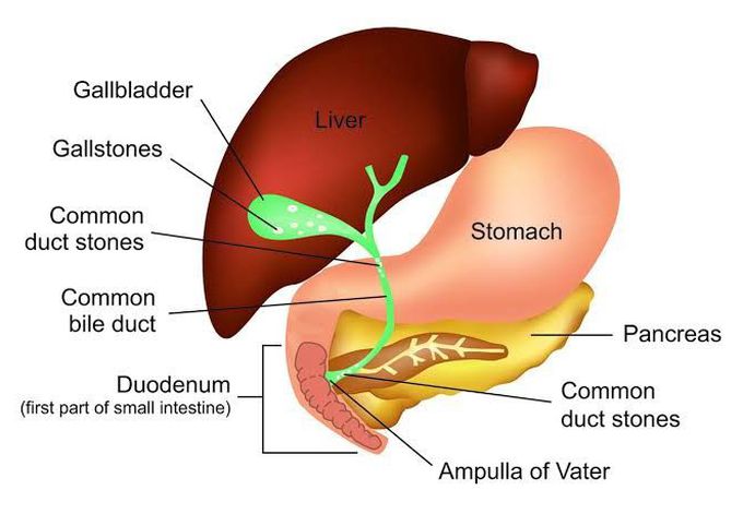 Cholelithiasis ( Cholecystitis) :  Symptoms, Causes,  Complications and Treatment by Nursesnote