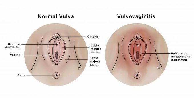 What Is Vulvovaginitis?