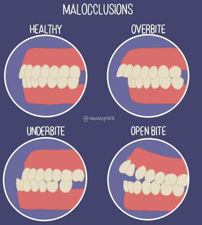 Malocclusion