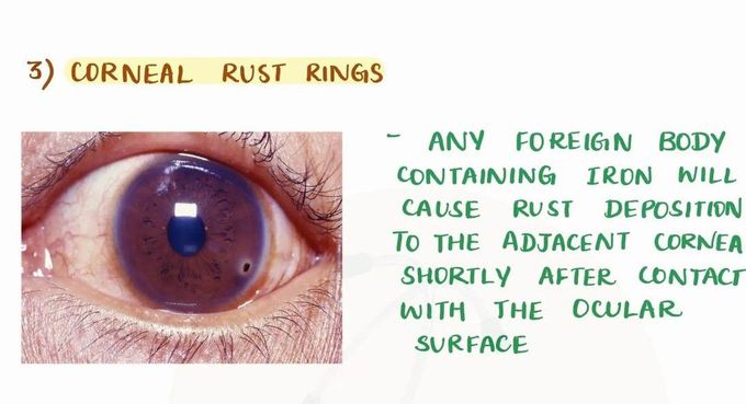 Corneal Rust Ring