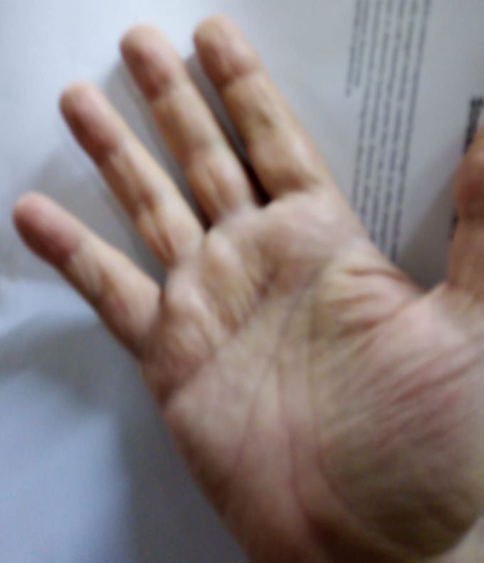 Severe pain in middle finger