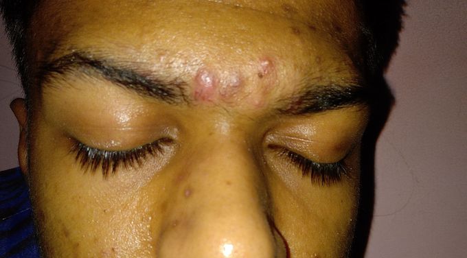 Acne Skin desise