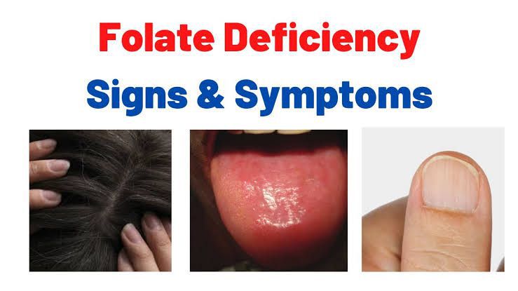 Treating folate deficiency anemia and its symptoms - MEDizzy