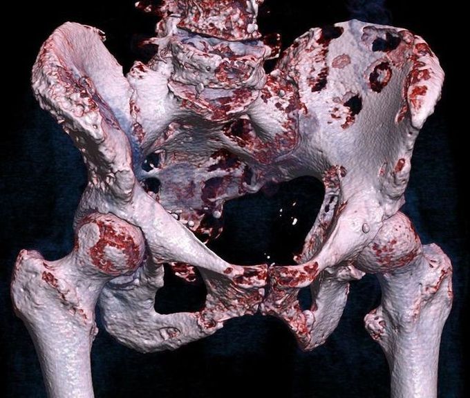 Bone Metastasis