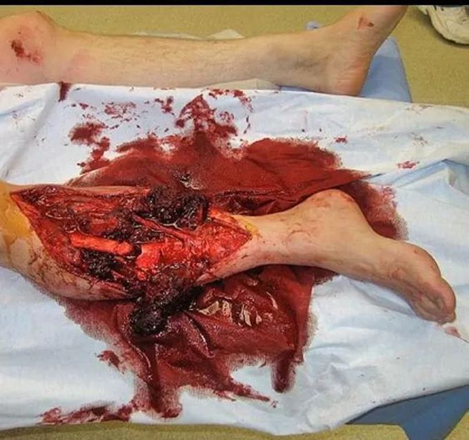 Leg Crush injury