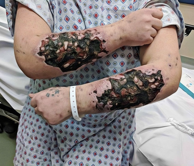 Male patient addicted to the drug “krokodil” with necrotic lesion on both forearms!