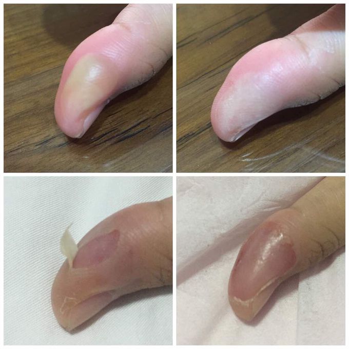 Is this condition going well ? Its burns .