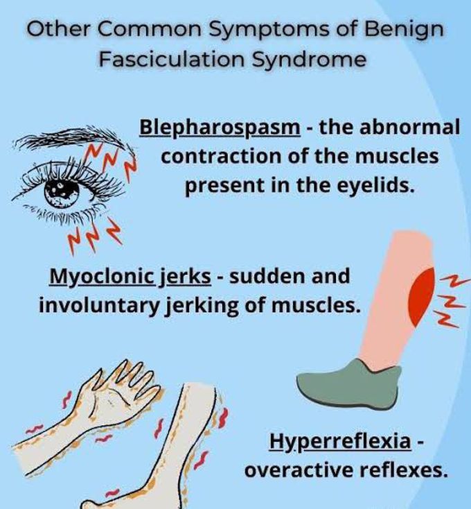 These are the symptoms of Benign fasciculation syndrome