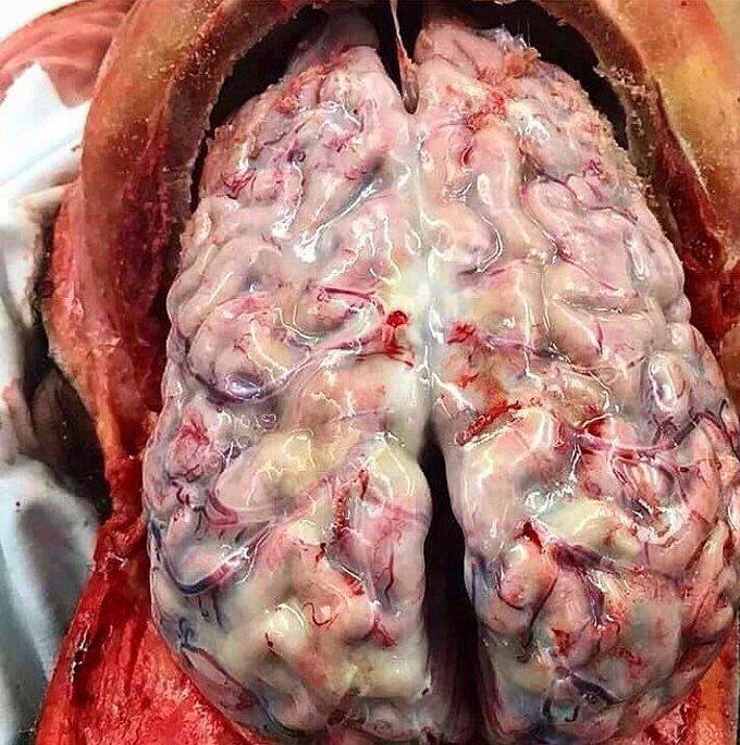 Bacterial meningitis!!