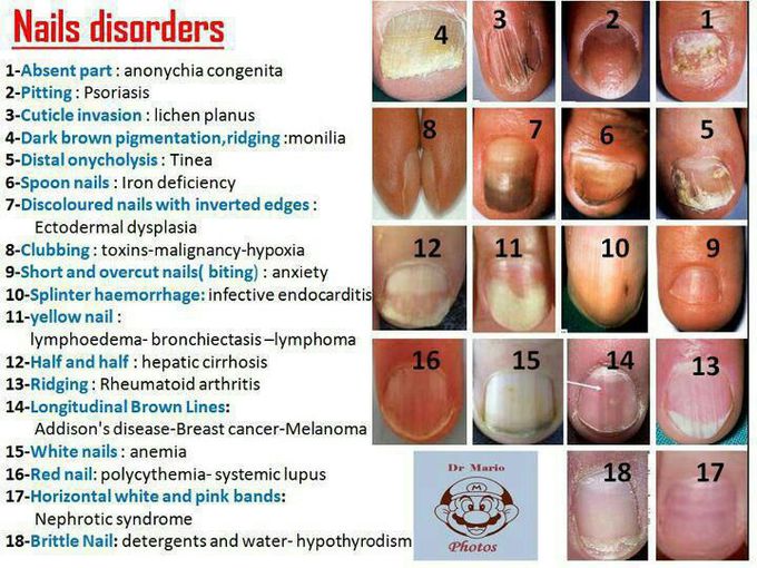 Nails disorders