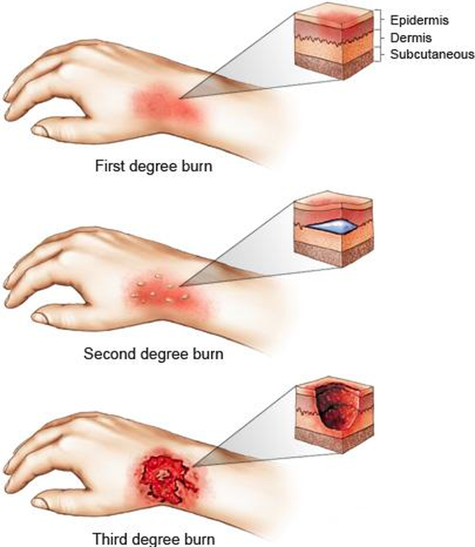 Types Of Burns Medizzy 7073