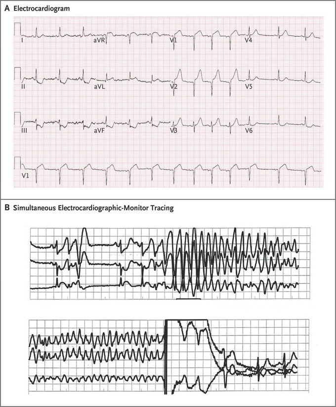 Ventricular Fibrillation during Left Ventriculography