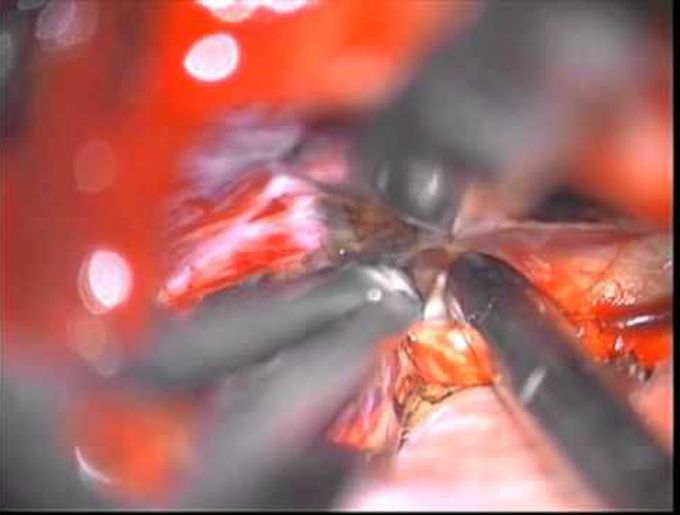 Microsurgical decompression of tumor of a rare posterior third ventricular pathology