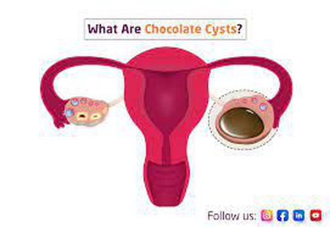 Chocolate cysts