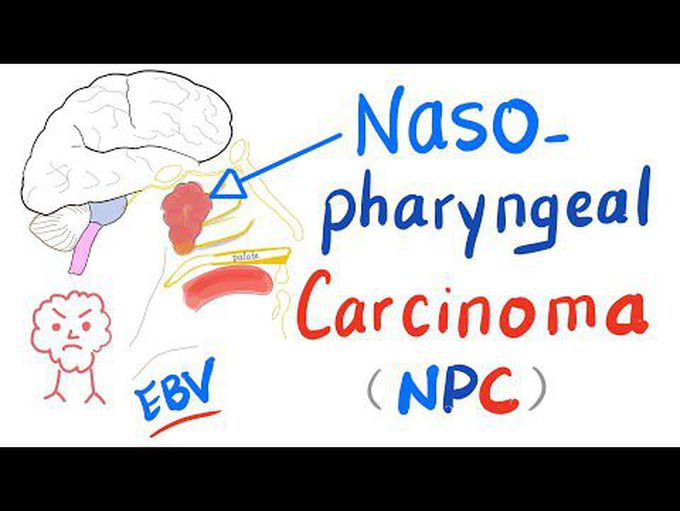 Cancer of Nasopharynx - Nasopharyngeal carcinoma (NPC)