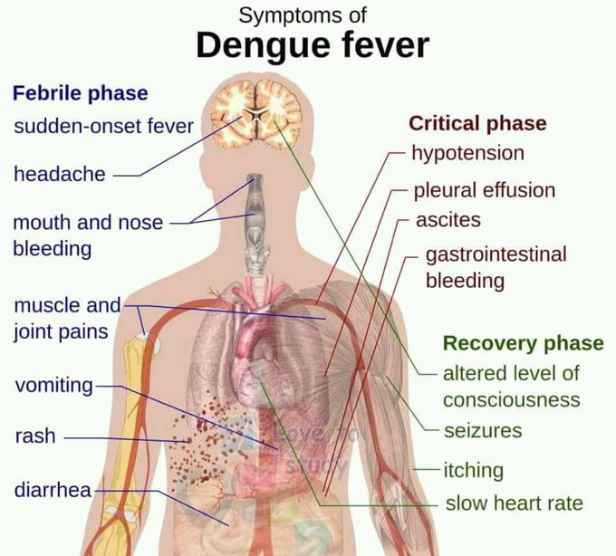 Dengue fever